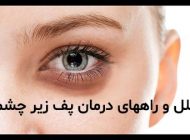 علل و راه های مختلف خانگی درمان پف زیر چشم