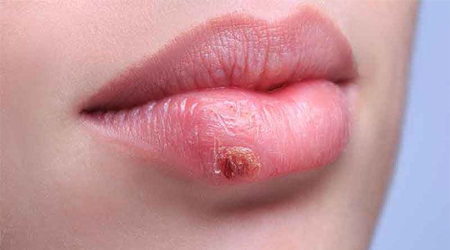 راه هایی برای درمان سریع تبخال لب + راه های پیشگیری و علل بروز تبخال
