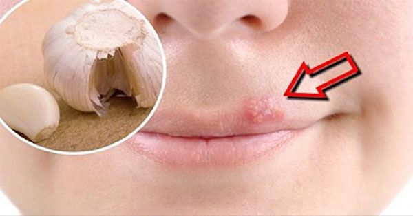راه هایی برای درمان سریع تبخال لب + راه های پیشگیری و علل بروز تبخال
