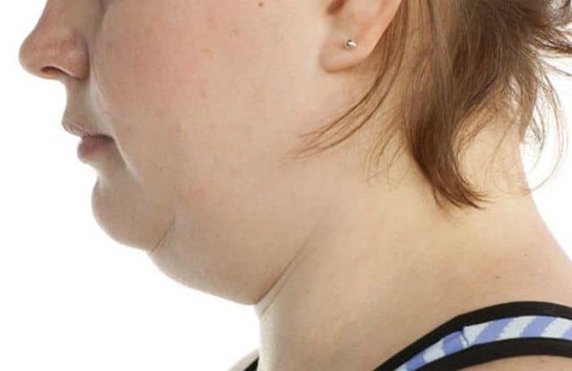 برای از بین بردن غبغب چه کنیم؟ (راهکارهای ساده و طبیعی)