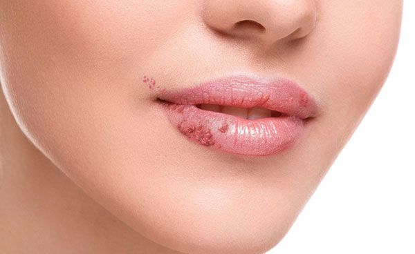 راه هایی برای درمان سریع تبخال لب + راه های پیشگیری و علل بروز تبخال