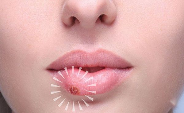 راه هایی برای درمان سریع تبخال لب + راه های پیشگیری و علل بروز تبخال