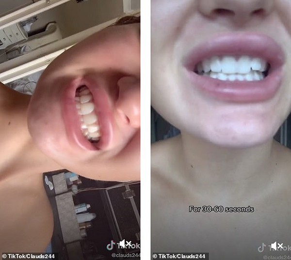 سفید کردن دندان با وایتکس چالش جدید TIK TOK