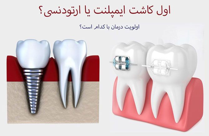 اول ایمپلنت یا ارتودنسی