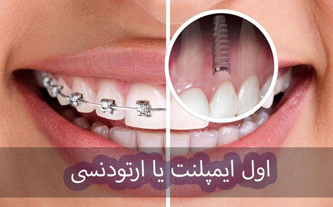 اول ایمپلنت یا ارتودنسی