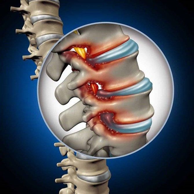 تنگی کانال نخاع گردن و کمر چگونه درمان میشود؟