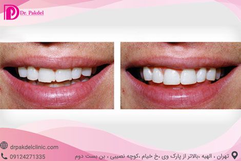 کامپوزیت دندان چیست؟ تفاوت کامپوزیت و لامینیت