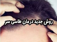 روش جدید درمان طاسی سر و افزایش تراکم مو