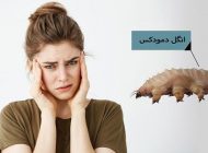 دمودکس و درمان آن