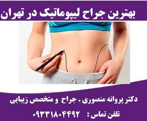 هزینه لیپوماتیک شکم و پهلو سال 1401