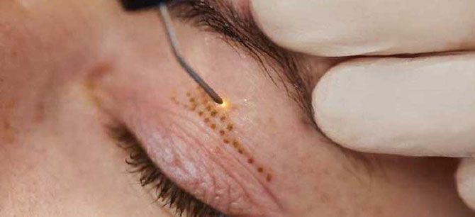 تجهیز کلینیک های زیبایی با کدام دستگاه ها؟ مقایسه کاربرد دستگاه پلاسما پلاسمارت