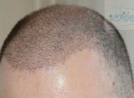 دو مورد از رایج ترین روش های کاشت مو را بشناسید