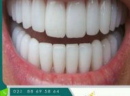 زمان ایده آل برای انجام ایمپلنت دندان کی است؟