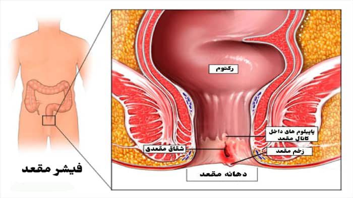 درمان قطعی شقاق؛ علت رایج خونریزی مقعدی