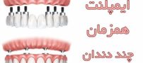 ایمپلنت همزمان چند دندان چیست ؟