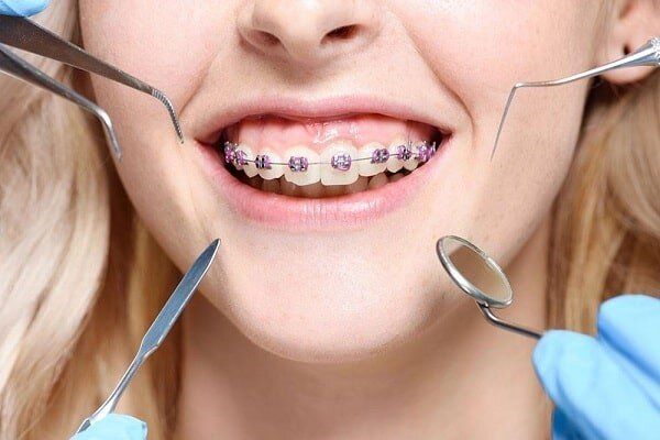 انواع روش های ارتودنسی دندان