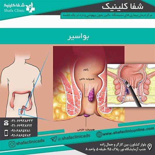درمان بیماری های نشیمنگاهی بدون خونریزی در شفا کلینیک