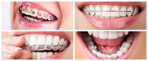 انواع روش های ارتودنسی دندان