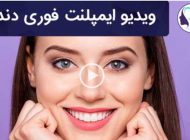 همه چیز درباره ایمپلنت دندان | کاشت دندان دائمی