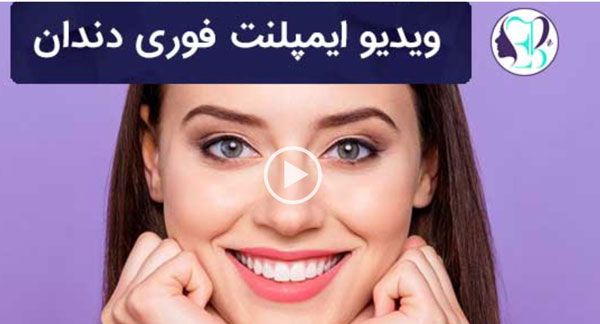 همه چیز درباره ایمپلنت دندان | کاشت دندان دائمی