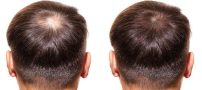 چگونه کاشت مو می تواند به شما در دستیابی به موهای پرتر و پرپشت تر کمک کند؟