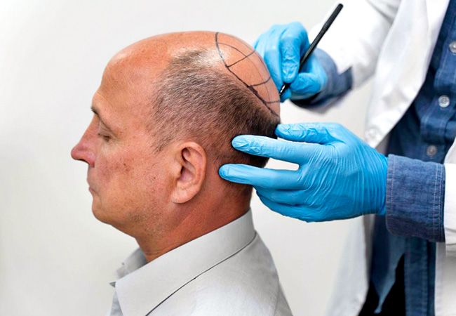 آیا کاشت مو می تواند موها را پرپشت کند؟