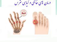 درمان گیاهی نقرس از منظر طب سنتی