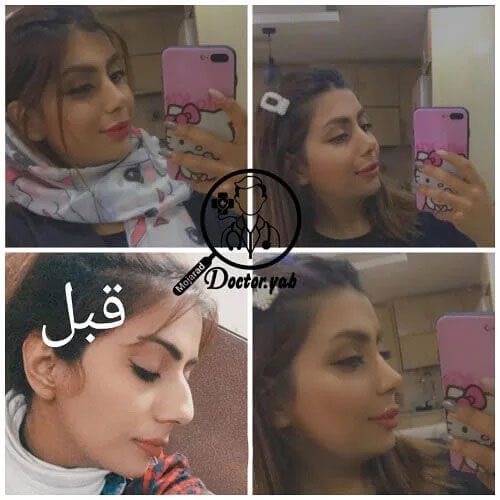 زیبایی بینی شما ارزشمند است🥰: بازسازی زیبایی و اعتماد به نفس با بهترین جراح بینی در شیراز