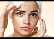 9 نکته برای مراقبت از پوست مستعد آکنه