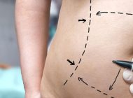 لیپوساکش چقدر روی کم شدن وزن و لاغری اثر می گذارد؟