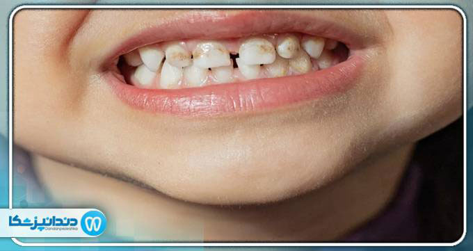 پوسیدگی دندان چیست؟