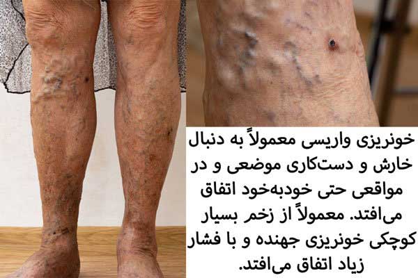 عوارض بیماری واریس