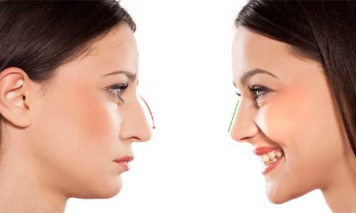 لیفت بینی با نخ بهتر است یا تزریق ژل (فیلر) | مقایسه هزینه، عوارض و ماندگاری