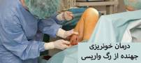 خونریزی جهنده از رگ واریس را چگونه درمان کنیم؟