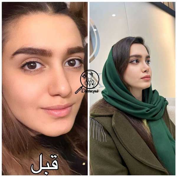 بهترین جراح بینی استخوانی در تهران