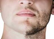 کاشت ابرو مردانه و ریش و سبیل با روش های نوین و تخصصی