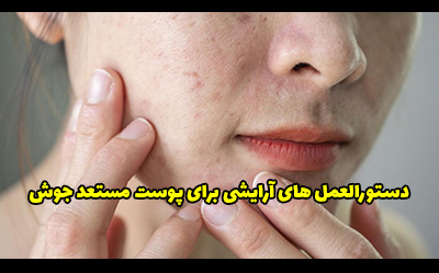 دستورالعمل های آرایشی برای پوست مستعد جوش