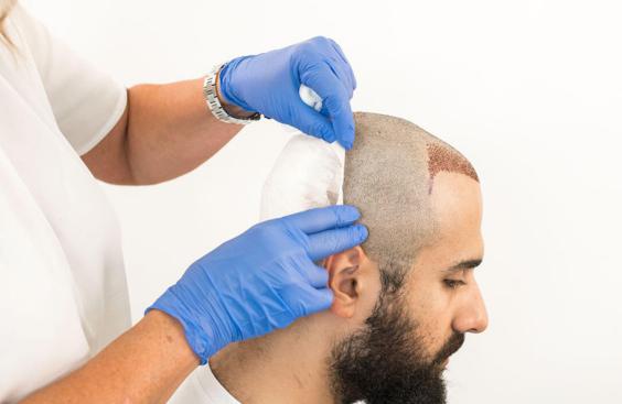 نحوه مراقبت از مو بعد از کاشت