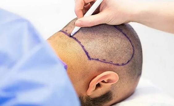 بهترین روش نحوه مراقبت از مو بعد از کاشت