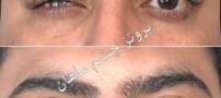 چشم مصنوعی معجزه ای برای بازگشت زیبایی چشمان از دست رفته شما