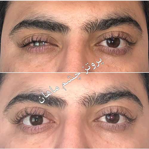 چشم مصنوعی معجزه ای برای بازگشت زیبایی چشمان از دست رفته شما