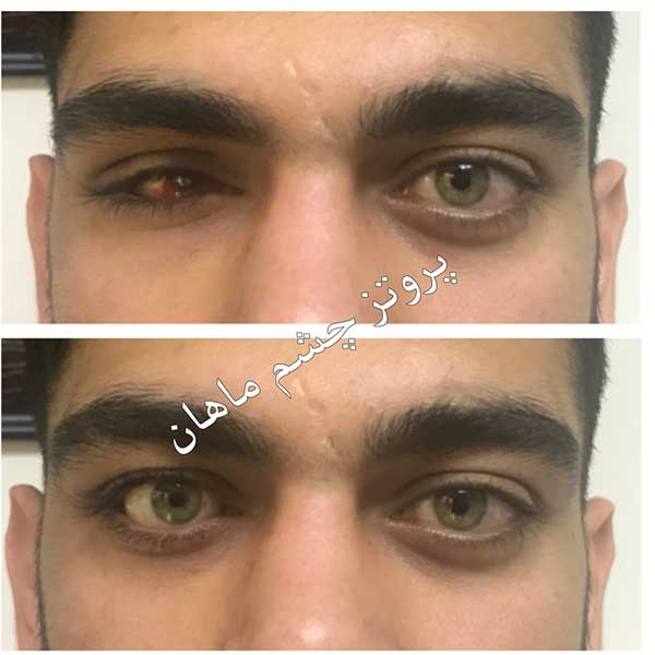 پروتز چشم
