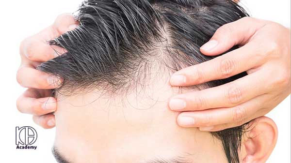 مزونیدلینگ مو چه طور انجام میشود؟