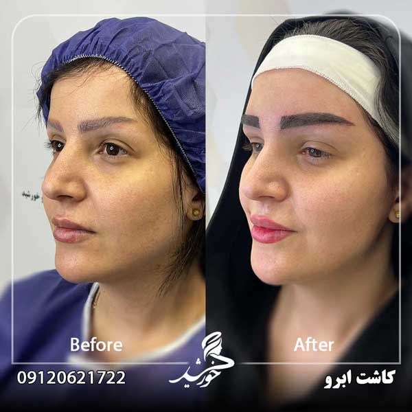 نمونه کاشت ابرو کلینیک خورشید