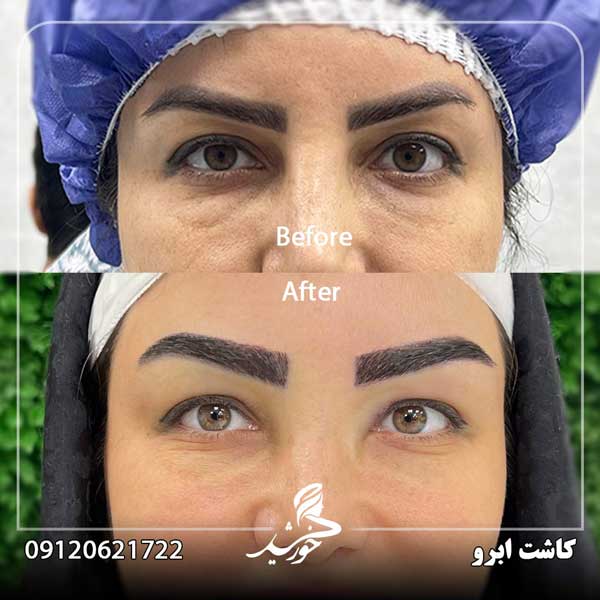 نمونه کاشت ابرو کلینیک خورشید