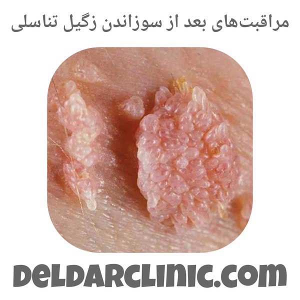 مراقبتهای بعد از سوزاندن زگیل تناسلی