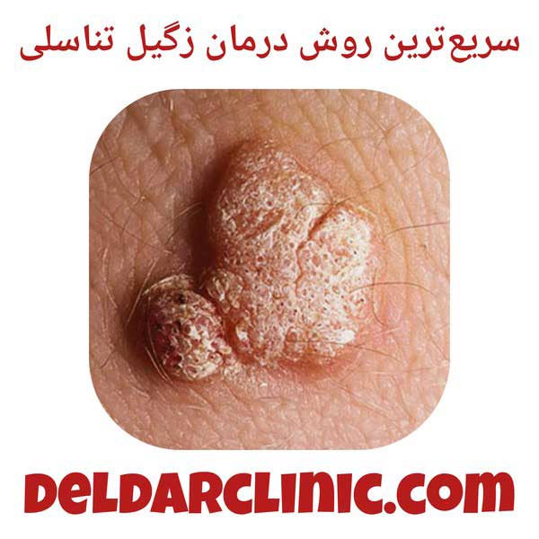 سریعترین روش درمان زگیل تناسلی