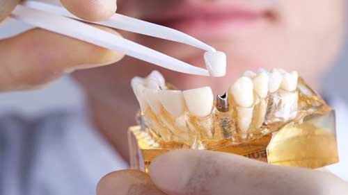چرا جراحی ایمپلنت دندان گران است؟