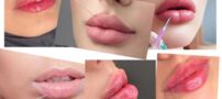 مدل های ترند تزریق ژل لب 1404