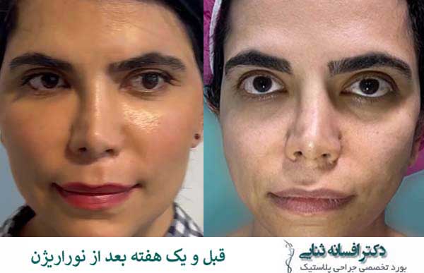 معجزه جوانسازی - نتیجه قبل و یک هفته بعد از تزریق چربی